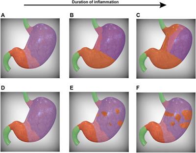 Follow the Metaplasia: Characteristics and Oncogenic Implications of Metaplasia’s Pattern of Spread Throughout the Stomach